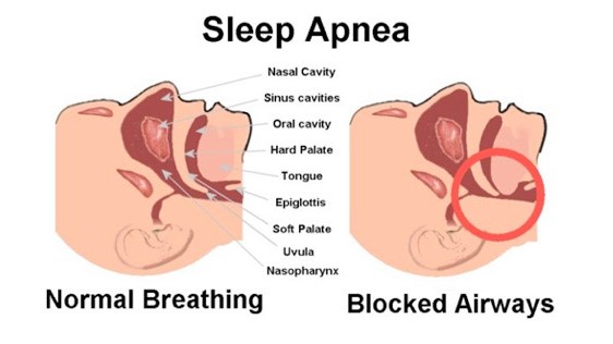 sleep apnea, normal breathing, blocked airway, sleep